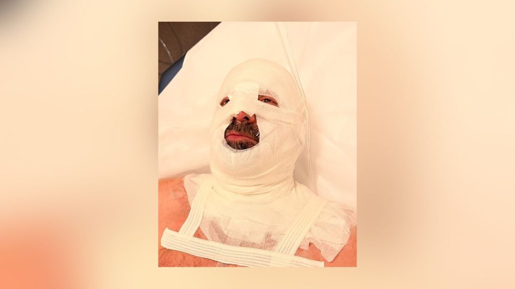 "À quoi bon se donner autant ?", la photo d'un maire d'un petit village normand gravement brûlé au visage fait le tour des réseaux sociaux
Un de ses administrés n'avait plus de chauffage. Ancien pompier, le maire, qui était occupé à dégager une route, s'est rendu à la chaudière municipale pour la remettre en route. Il s'est pris un retour de flamme.